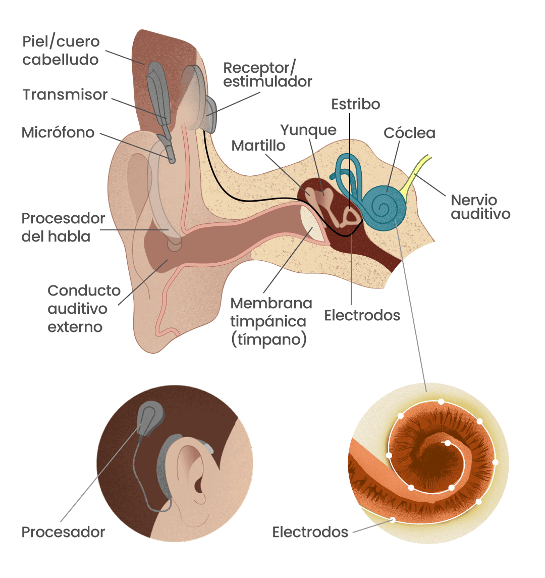 ¿Cómo funciona el implante coclear? Ilustración de Paula De la Cruz para GK.