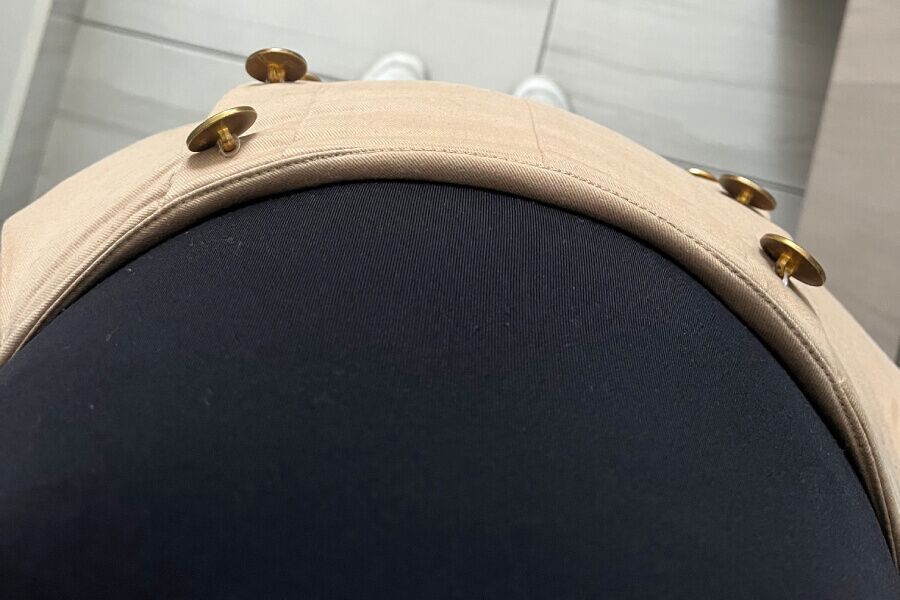 abdomen hinchado es consecuencia de la endometriosis